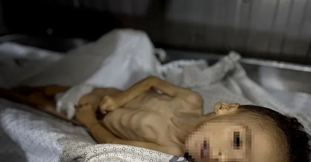 İsrail'in yol açtığı kıtlık nedeniyle Gazze'de 5 yaşındaki çocuk açlıktan yaşamını yitirdi