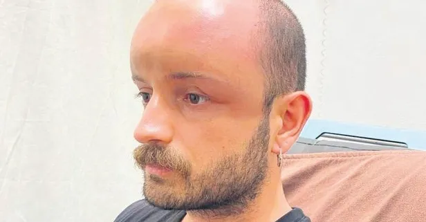 Böyle vaka görülmedi! Nem oranın yüksek olduğu saatlerde güneşlenen gencin kafasında ödem oluştu