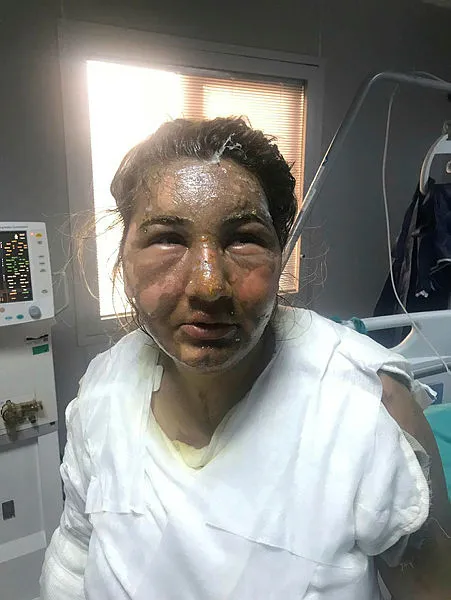 Eski eşinin önce bıçaklayıp sonra da kızgın yağ dökerek yaktığı kadın yaşadığı dehşeti anlattı-2