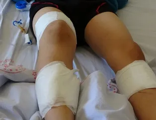 Bingöl’de 7 yaşındaki çocuk köpeklerin saldırısına uğradı