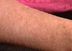 Vücudundan tüy yerine tırnak çıkıyor