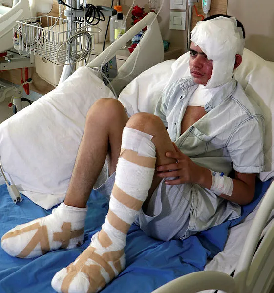 karsta-buzagi-otlatirken-kopan-yuksek-gerilim-akimina-kapilan-ebubekirin-ayak-tabanlari-patladi-1594805758310.jpg Kars'ta buzağı otlatırken kopan yüksek gerilim akımına kapılan Ebubekir'in ayak tabanları patladı-3