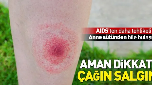 aids ten bile tehlikeli olan lyme