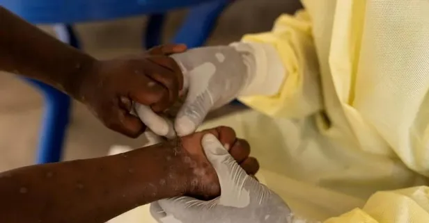 ''M çiçeği'' virüsü Avrupa'ya da sıçradı: İsveç ilk vakayı doğruladı! | DSÖ'den 'acil durum' BM'den ek bütçe çağrısı