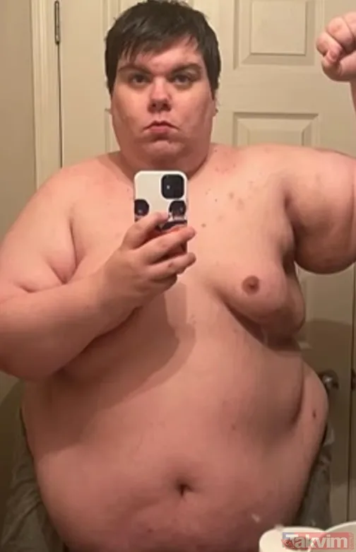 22 Kilogramlık Deri Yükünden Kurtuldu 136 Kilodan Fazla Verdikten Sonra Mulley'nin Vücudunda Hareketini Kısıtlayan Ve Yaklaşık 22 Kilogram (48 Pound)...