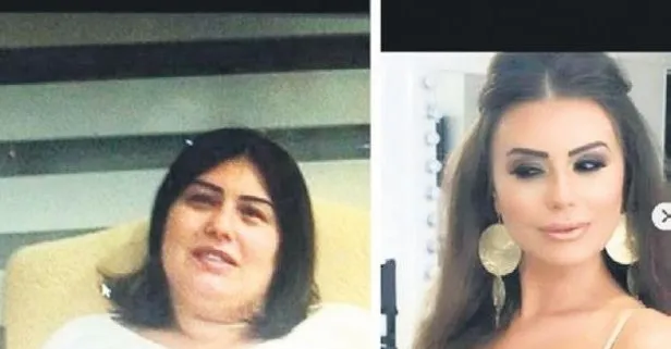 Yuruyen Estetik Gullu Kose Dokuz Yilda 22 Kez Ameliyat Masasina Yatti Takvim