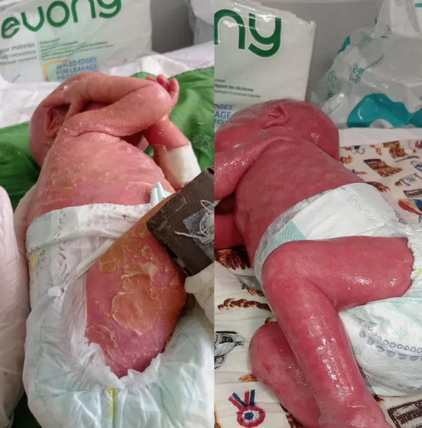 300-milyonda-bir-gorulen-yilan-hastaligi-harlequin-tipi-iktiyozis-ile-dogan-gokdeniz-bebek-1-yasinda-gunde-1-k-1644303245910.jpg 300 milyonda bir görülen yılan hastalığı (Harlequin tipi iktiyozis) ile doğan Gökdeniz Bebek 1 yaşında! Günde 1 kilo vazelin 2 tüp krem bitiyor-7