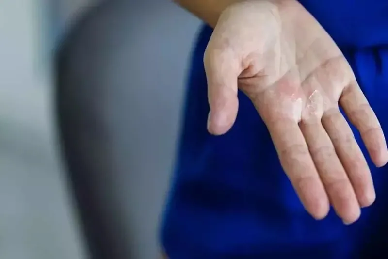 elleriniz-hep-usuyorsa-nedeni-bu-olabilir-1-dakikada-raynaud-hastaligi-testi-1731849018881.jpeg 1 dakikada Raynaud hastalığı testi: Elleriniz hep üşüyorsa nedeni bu olabilir!-5