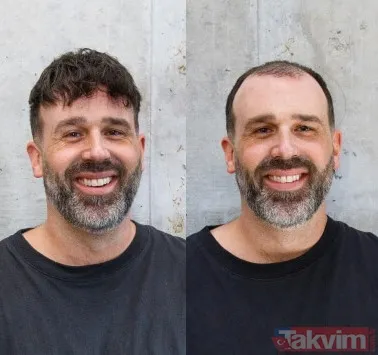 Bilim Ne Diyor? Saç Dökülmesinin Psikolojik Etkileri Azımsanmayacak Kadar Büyük. Dermatolog Dr. David Fenton, Özellikle Genç Bireylerde Saç Dökülmesinin...