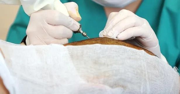 Saç ekiminde Türkiye dünya markası!