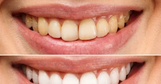 Dişlerdeki tartarları yok edip beyazlatıyor! Bir tutam fırçaya sürün dişleriniz inci beyazı gibi olsun!