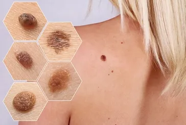 Güneşe fazla maruz kalanlar dikkat! O kanser türü hiç beklenmedik yerlerde bile etkili olabilir! En yaygın...