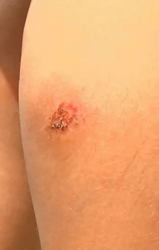 Isırdığı yerde yara çıkıyor! İstanbul'da sivrisinek paniği! Vatandaşlar tedirgin oluyor