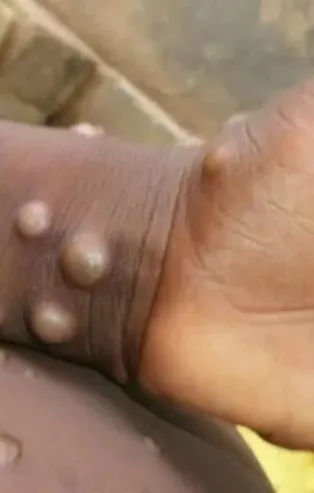 Dünya alarmda! 5 ülkede görüldü! Maymun çiçeği salgını Avrupa'yı vurdu! Maymun çiçeği hastalığı nedir, nasıl bulaşır, tedavisi var mı?