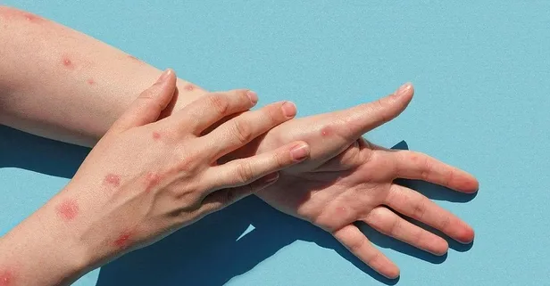 Avrupa'dan sonra Asya'dan da ilk vaka haberi geldi! Maymun Çiçeği yayılıyor! Belirtileri neler? Nasıl bulaşıyor? Uzman isim uyardı: Çiçek aşısı olanlar hafif geçiriyor