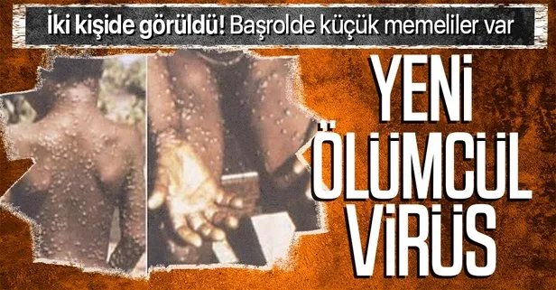 SON DAKİKA: Koronavirüs henüz bitmemişken İngiltere’de yeni salgın! Ölümcül maymun çiçeği hastalığı görüldü