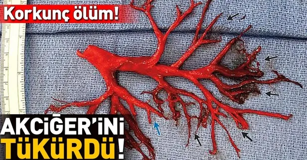 Akciğerini öksürdü, hayatını kaybetti