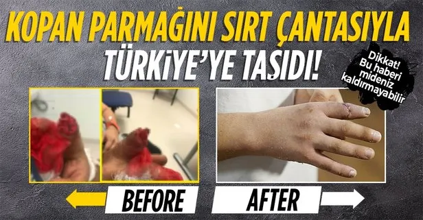 Malta’da kopan parmağını sırt çantasında Türkiye’ye getirdi! Bu ameliyatın dünyada örneği yok!