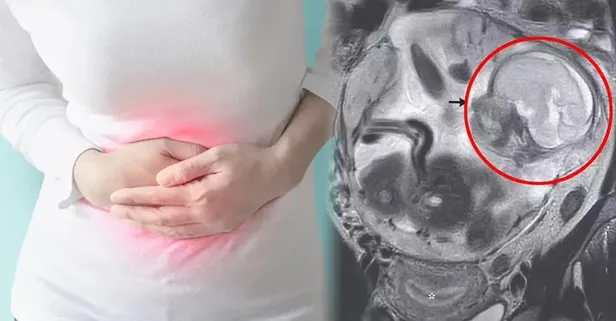 Mide ağrısıyla gitti 5,5 aylık hamile olduğunu öğrendi! Bağırsakta büyüyen bebek olayı nedir? Ektopik gebelik nedir, tedavisi var mı?