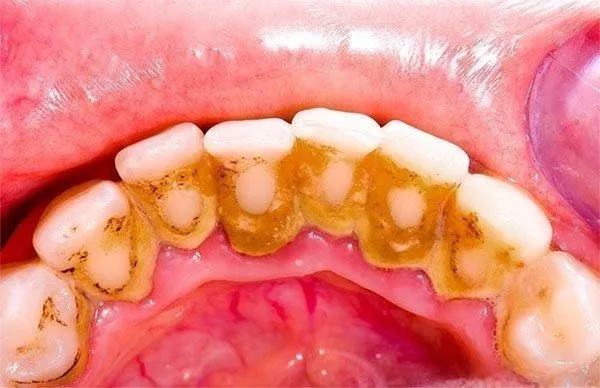 Diş taşlarınızı doğal yöntemlerle yok etmenin yolları-1