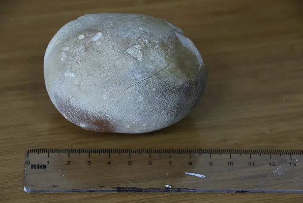Samsun'da doktorları şoke eden olay: Görünce patates sandım-2