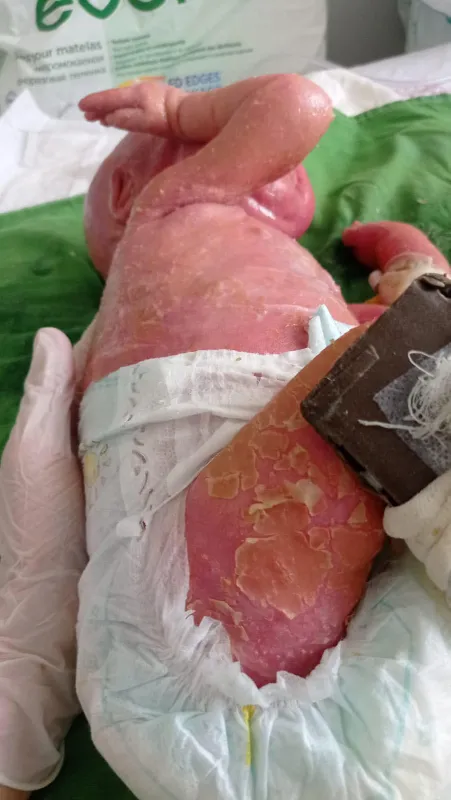 300-milyonda-bir-gorulen-yilan-hastaligi-harlequin-tipi-iktiyozis-ile-dogan-gokdeniz-bebek-1-yasinda-gunde-1-k-1644303243963.jpg 300 milyonda bir görülen yılan hastalığı (Harlequin tipi iktiyozis) ile doğan Gökdeniz Bebek 1 yaşında! Günde 1 kilo vazelin 2 tüp krem bitiyor-4