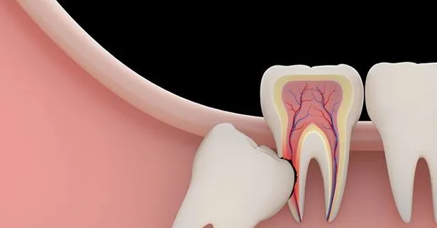20’lik diş kabus olmasın