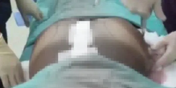 SON DAKİKA: İstanbul'da 'kalça estetiği' faciası: Brezilya kalçası istedi ölümden döndü-4