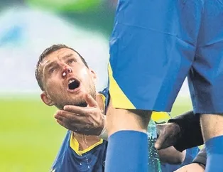 Dzeko’nun burnu kırıldı