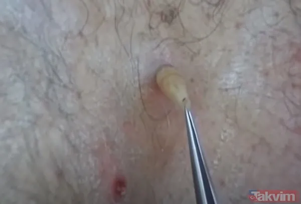 Karnındaki şişlik için gitti içinden çıkan doktorları bile şoke etti! Yer uzak değil Kayseri! 64 kilo girdi 55 kilo çıktı - 43