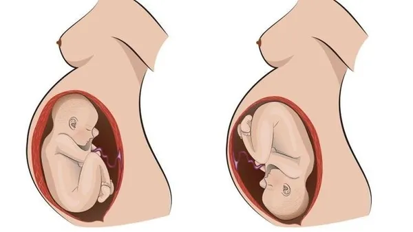 ters-dogum-nedir-dogum-kocu-evde-dogum-yaptirdi-ters-gelen-bebek-oksijensizlikten-oldu-1641992784318.jpg Ters doğum nedir? Doğum koçu evde doğum yaptırdı! Ters gelen bebek oksijensizlikten öldü-5