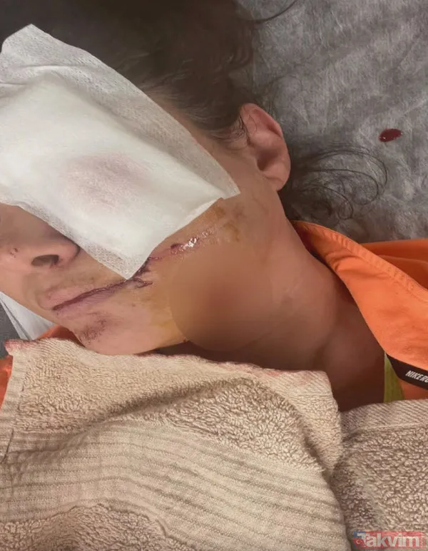 Tuğba Altıntop 'köpek saldırısına uğradım' demişti! Son haliyle ortaya çıktı! Rafet El Roman kaybettiğine dönüp bakınca başını taşlara vuruyor - 2