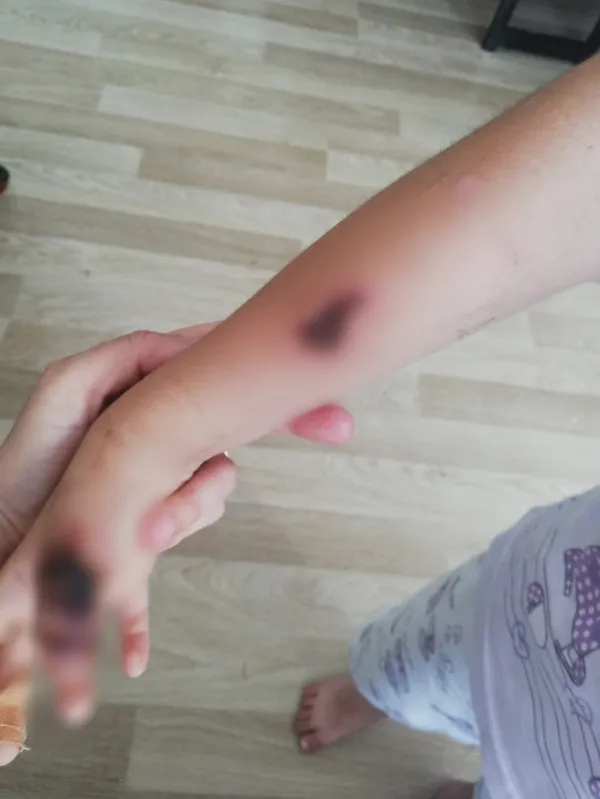 6-yasindaki-elif-kucuksorgulunun-girdigi-mr-sonrasi-eli-ve-kolunda-yaniklar-olustu-anneden-isyan-eden-sozler-1653904281076.jpg 6 yaşındaki Elif Küçüksorgulu'nun girdiği MR sonrası eli ve kolunda yanıklar oluştu! Anneden isyan eden sözler-7