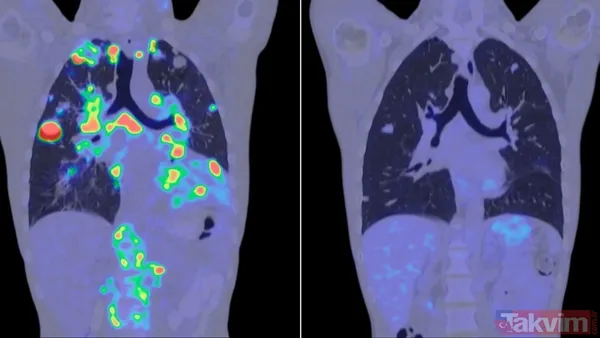 Geç kalma farkına var! 4 Şubat Dünya Kanser Günü anlam ve önemi - 5