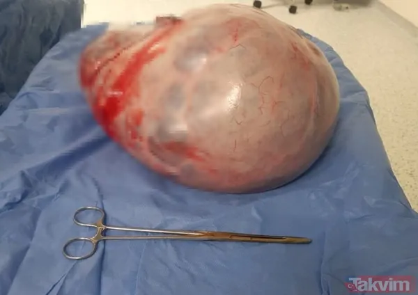 Karnındaki şişlik için gitti içinden çıkan doktorları bile şoke etti! Yer uzak değil Kayseri! 64 kilo girdi 55 kilo çıktı - 3