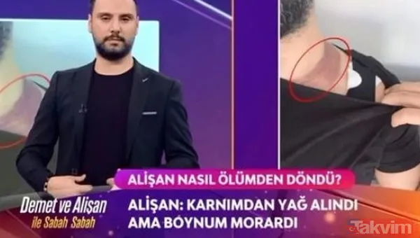 Alişan ölümden döndü soluğu eşiyle birlikte mahkemede aldı! Alişan'ın 12 milyonluk 'yağ aldırma' davasında her yeri mosmor olmuştu - 4