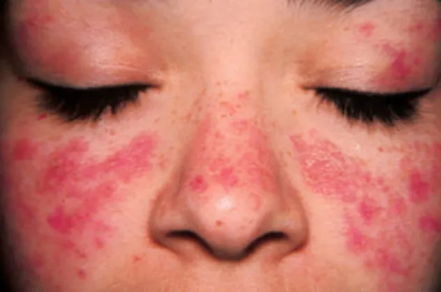 Lupus hastalığı (SLE hastalığı) nedir? Lupus hastalığı ölümcül müdür?