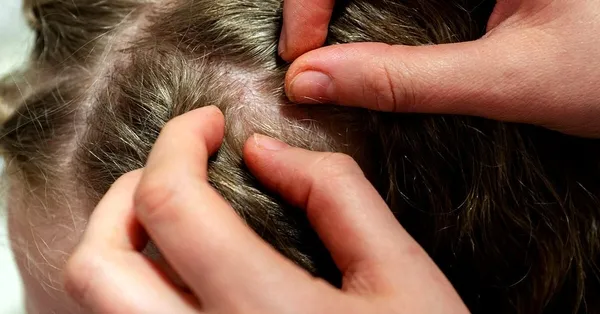 Rüyada bit görmek ne anlama gelir? Rüyada bit ayıklamak hayırlı mıdır