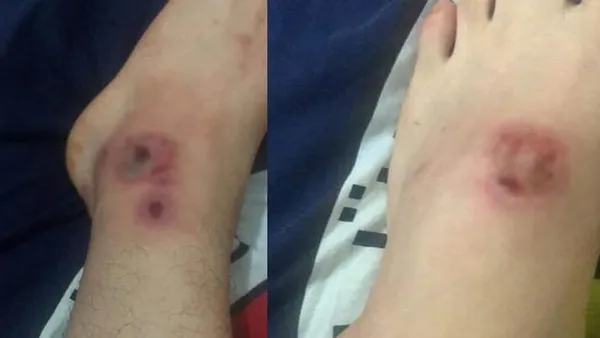 O ilde büyük panik! Isırdığı yeri çürütüyor! 'Asya Kaplanı' denilen...-2