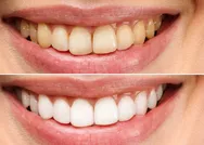 Dişlerdeki tartarları yok edip beyazlatıyor! Bir tutam fırçaya sürün dişleriniz inci beyazı gibi olsun!