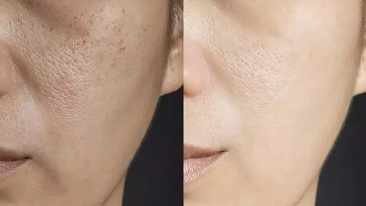 cildiniz-boyle-gorunuyorsa-3-sebebi-var-30-gunde-gozenek-kucultmenin-sirri-verildi-1719407051499.jpeg 30 günde gözenek küçültmenin sırrı verildi! Cildiniz böyle görünüyorsa 3 sebebi var!-5