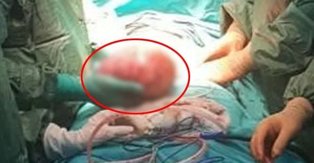 Karnından çıkan şoke etti! Tam 3 kilo...