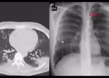 Koronavirüse yakalanan genç doktor 10 günde 8 kilo verdi! Tomografi görüntüsüyle uyardı!
