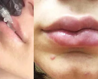 24 yaşındaki Ece Deniz’in dudağı dolgu sonrası yamuldu!