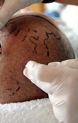 İstanbul'da saç ekimi ölüme götürdü