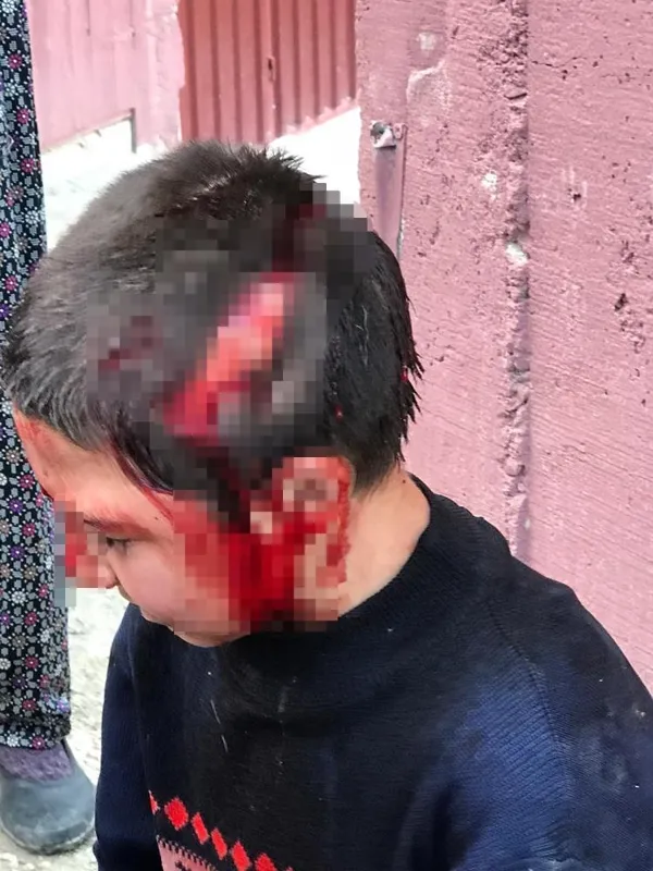 arkadaslariyla-oynarken-komsu-kopeginin-saldirisina-ugrayan-8-yasindaki-sevket-olumden-dondu-1621670172957.jpg Arkadaşlarıyla oynarken komşu köpeğinin saldırısına uğrayan 8 yaşındaki Şevket ölümden döndü-4