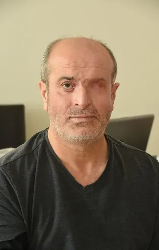 Hayatının şokunu yaşadı! Hiç tanımadığı biri yüzüne kezzap attı