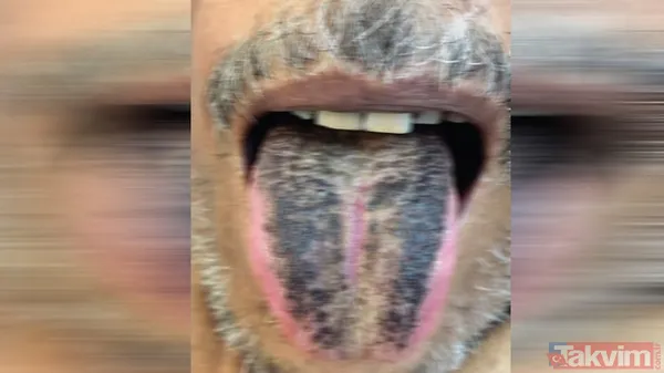 Akılalmaz hastalık doktorları bile şoke etti! Ağzının içinde bir anda başladı şimdi bakmak cesaret ister - 1