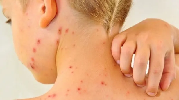 bakan-koca-uyardi-maymun-cicegi-virusu-turkiyede-hangi-ilde-goruldu-maymun-cicegi-virusu-belirtileri-neler-nas-1656572240983.jpg BAKAN KOCA UYARDI! Maymun Çiçeği Virüsü Türkiye'de hangi ilde görüldü? Hangi hastanede? Maymun Çiçeği virüsü belirtileri neler, nasıl bulaşır?-3