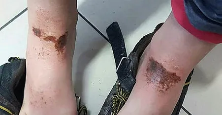 Afyonkarahisar'da kar topu oynayan çocukların üzerindeki yanıkların nedeni belli oldu!-4